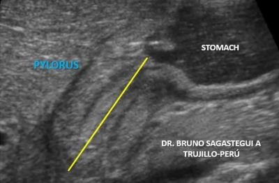 Longitudinal plane through right upper quadrant