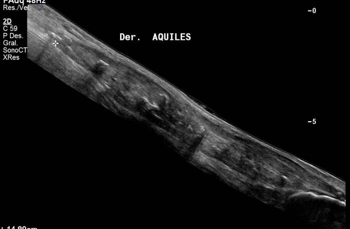 Longitudinal view of R Achilles tendon. (Extended field-of-view)