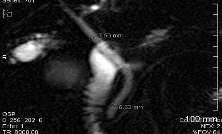 gallbladder adenomyomatosis คือ อะไร ไขข้อสงสัยนับยอดเทิร์นยังไง