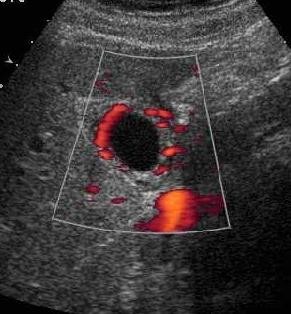 Power Doppler scan