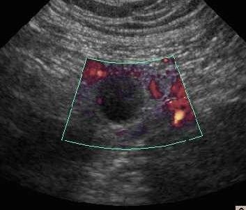 Power Doppler study of the right lower quadrant