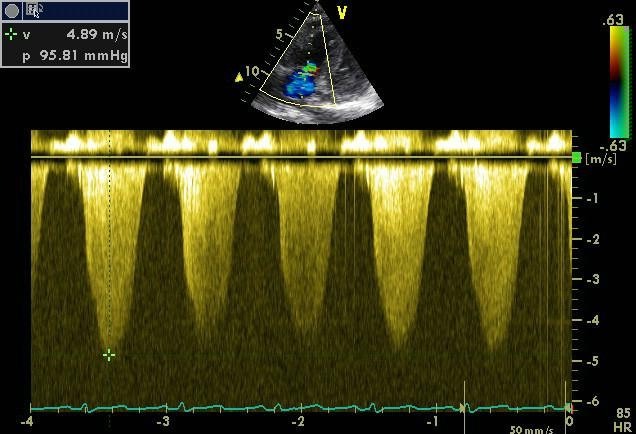 Pulmonary Hypertension TR Signal