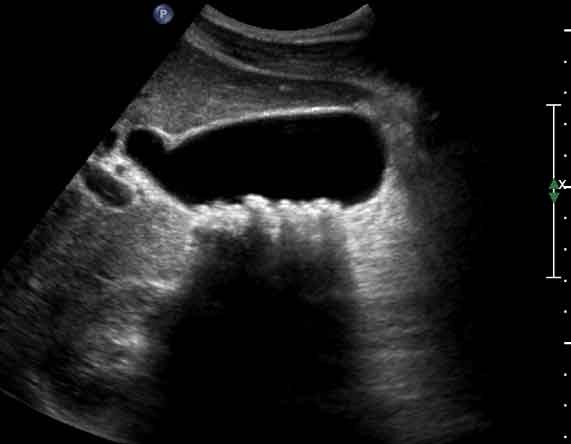 Sagittal View of Gallbladder