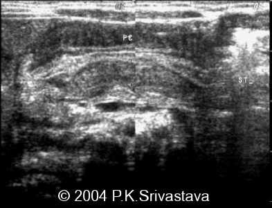 Sagittal image of the epigastric region (congenital)