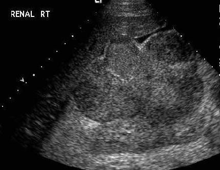 Sagittal view of the right hypochondrium