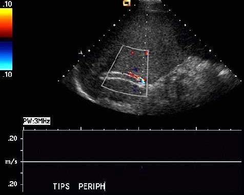 Spectral Doppler of the TIPS stent (picture 2)