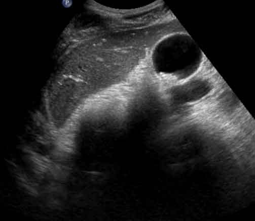 Transverse Image of Right Upper Quadrant