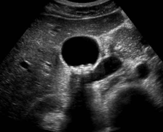 gallbladder ultrasound transverse