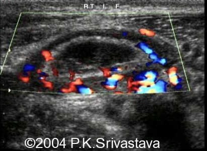 Transverse color Doppler image