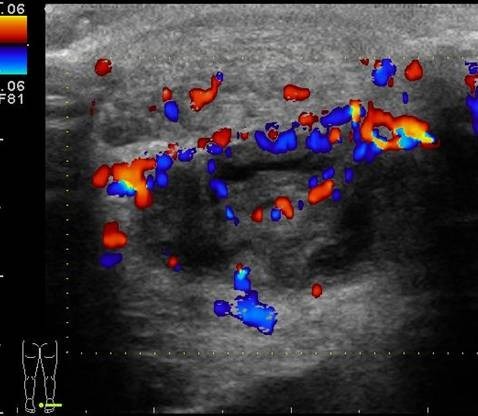 Transverse color doppler image of the right distal Achilles tendon