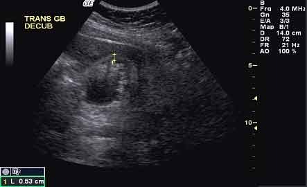 Transverse gallbladder