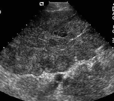 Transverse image below the level of the umbilicus