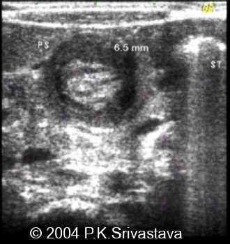 pyloric stenosis shoulder sign