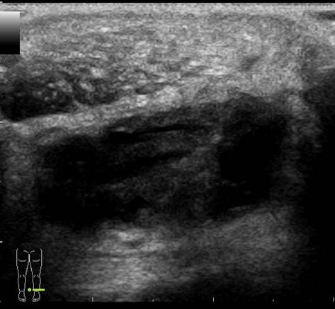 Transverse image of the right distal Achilles tendon