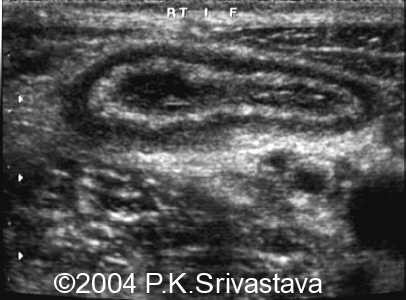 Transverse image of the right iliac fossa