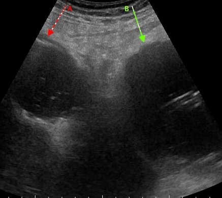 Transverse image of the upper abdomen