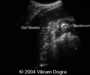 abnormal gallbladder ultrasound