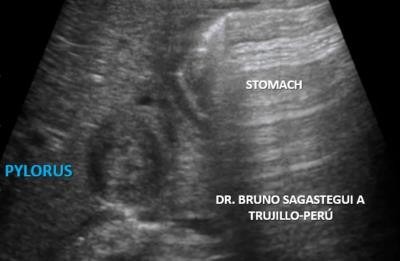 Transverse plane through right upper quadrant