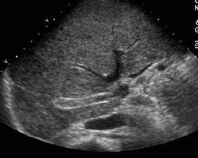 Transverse sonogram of the liver