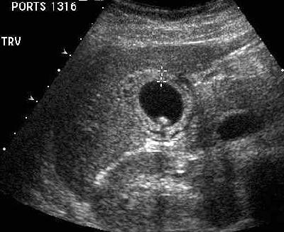 Transverse view of the gallbladder