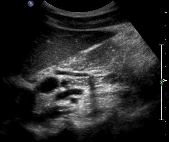 cholelithiasis ultrasound