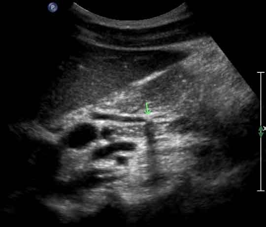 View of Common Bile Duct (picture 3)