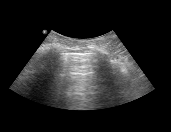 Bat sign ultrasound image.