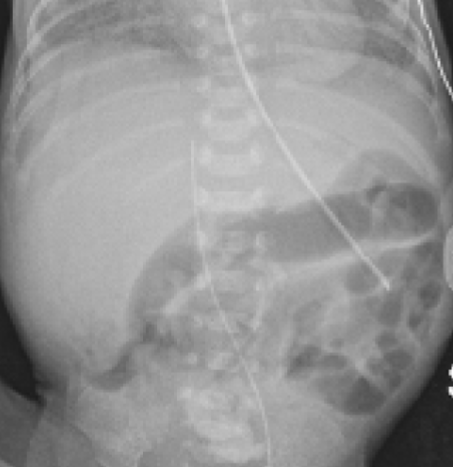 Abdominal X-ray of an infant.