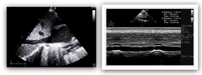 Ultrasound image of normal IVC variability during inspiration and expiration