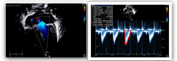 Ultrasound image of LVOT blood flow.