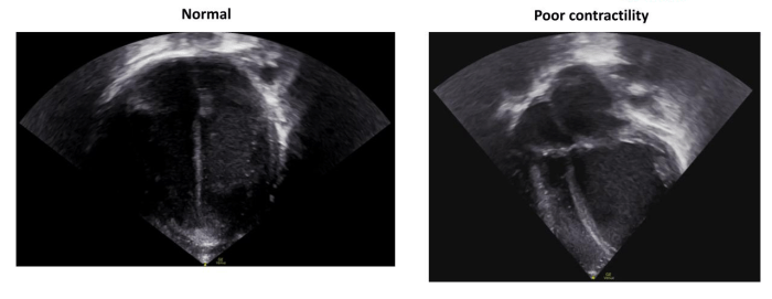 Ultrasound image A4C showing poor contractility and wall motion and normal image.