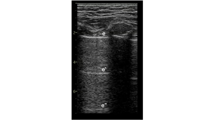 Chest ultrasound image.