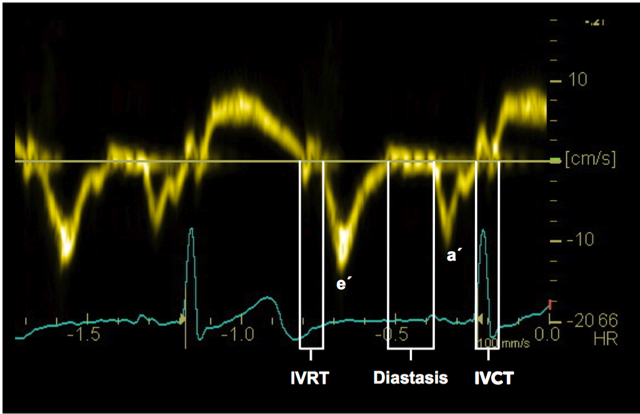 LV diastolic patterns measured by transmitral Doppler of the