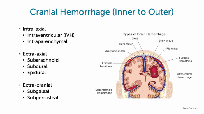 Illustration of Cranial Hemorrhage (Inner to Outer).