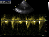 Pulsed-wave Doppler