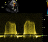 Pulmonary regurgitation, CW Doppler spectrum