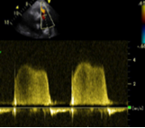 Pulmonary regurgitation, CW Doppler spectrum Pulmonary regurgitation, CW Doppler spectrum