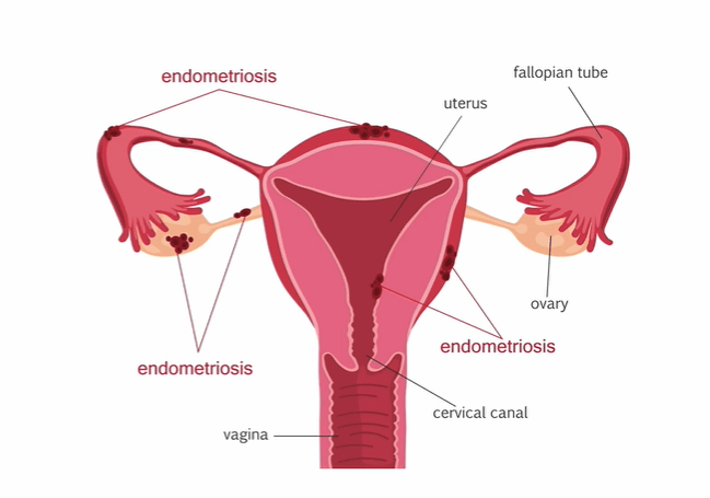 Illustration of common locations of endometriosis.