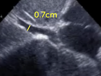 Normal size of the inferior vena cava Normal size of the inferior vena cava