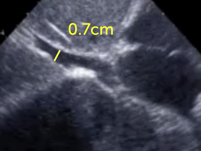 Normal size of the inferior vena cava