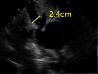 dilated inferior vena cava dilated inferior vena cava