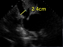 dilated inferior vena cava