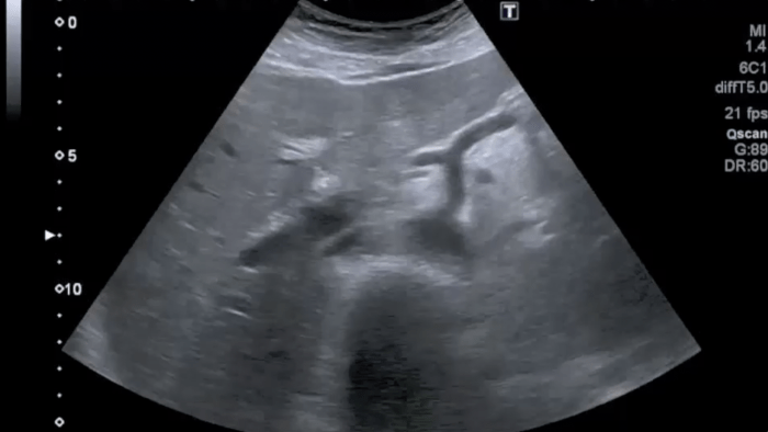 Ultrasound image of what looks like a tale of a whale.