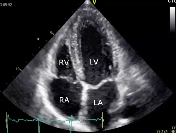 4-chamber view of the heart, the apex with the left ventricle (LV), then the mitral valve and the left atrium (LA). On the left side of the image, you can see the right atrium (RA), and the right ventricle (RV)