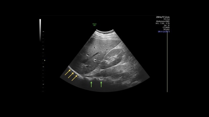 Ultrasound image of liver and right kidney with hyperechoic structure with acoustic shadowing behind it.