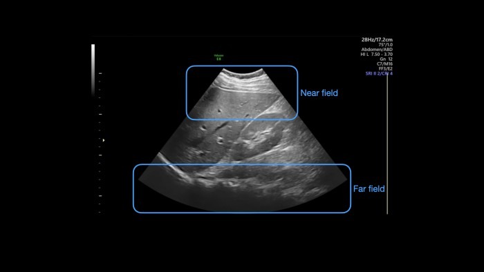 Ultrasound image of liver and right kidney with near and far field marked.