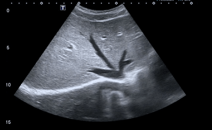 Ultrasound image of pathology that looks like a bunny.