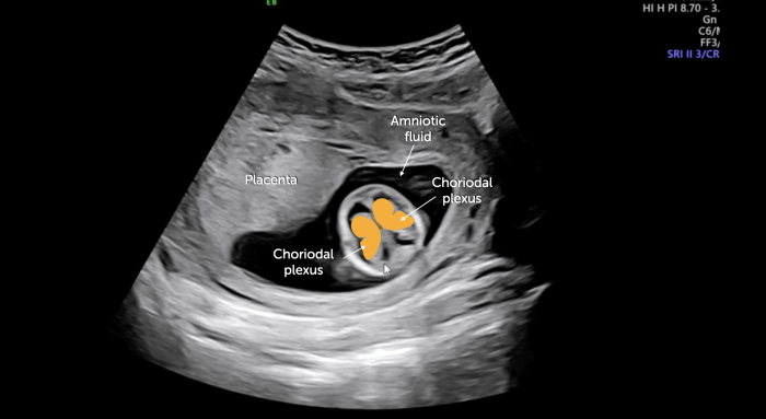 Ultrasound image of brain with what looks like a butterfly with labels.