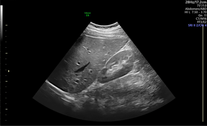 Ultrasound image of upper abdomen.