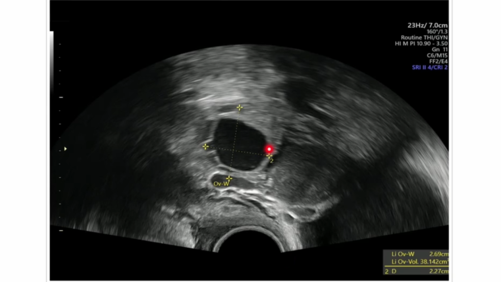 Ultrasound image of PCOS.